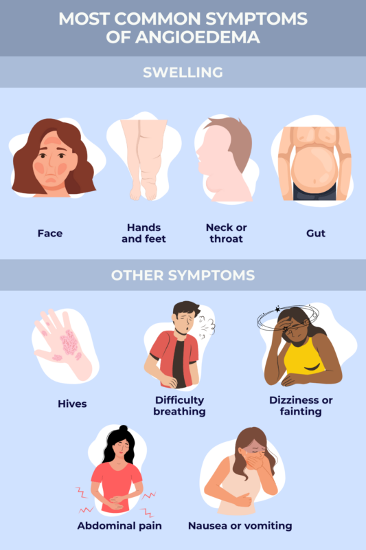 infographic of the most common angioedema symptoms