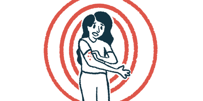 Illustration of woman with red marks or hives on her arm.