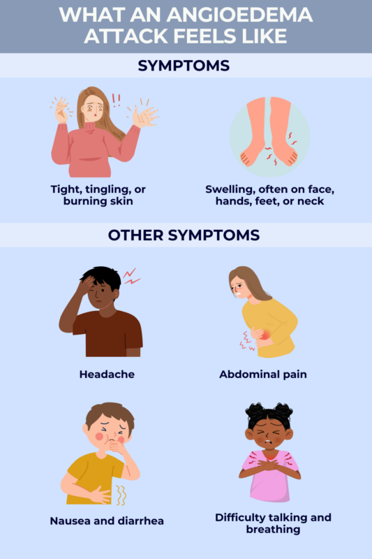 What angioedema attacks feel like infographic