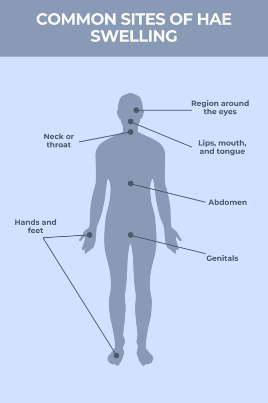 Common sites of HAE swelling infographic